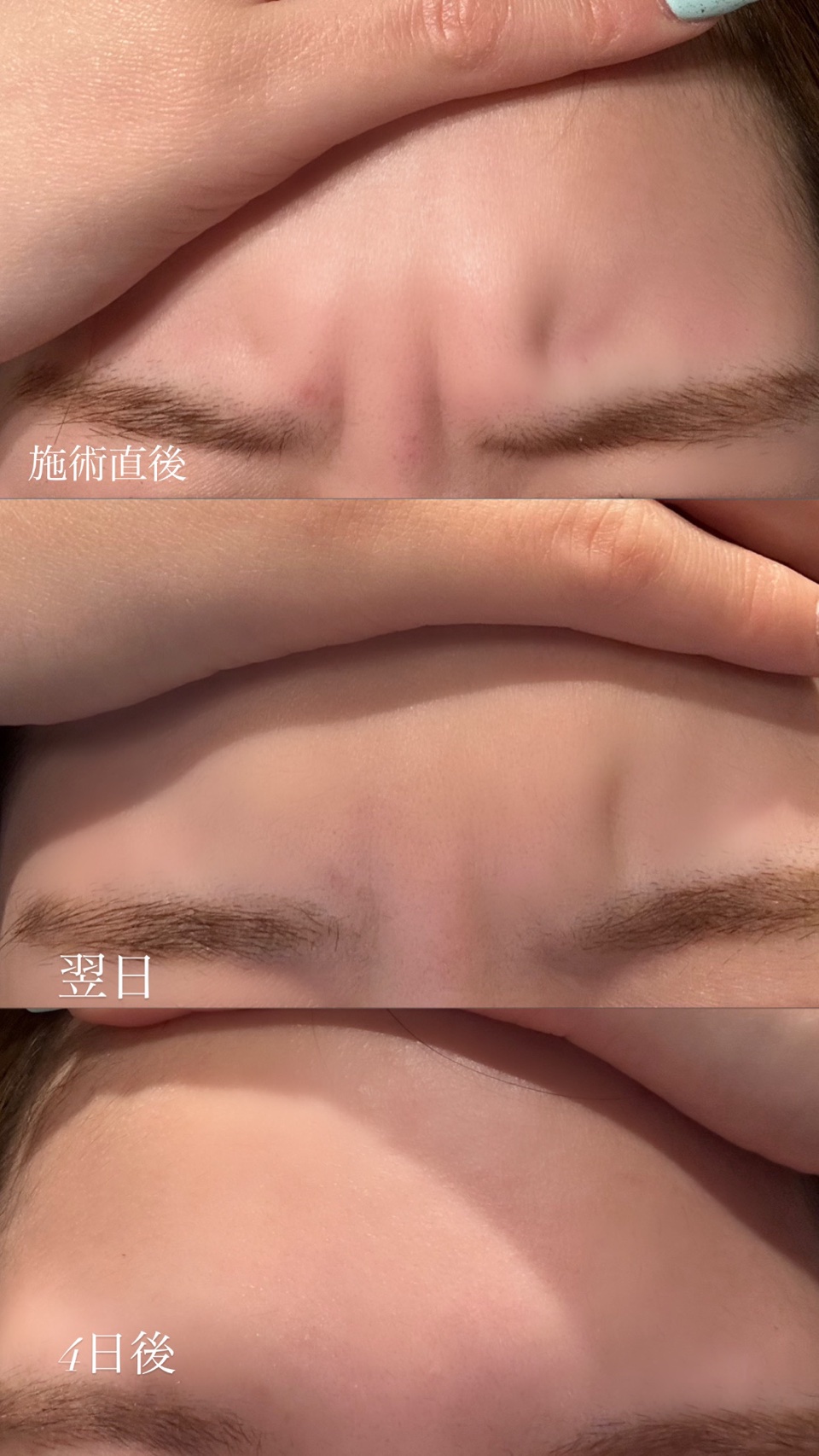 ボトックスの効果